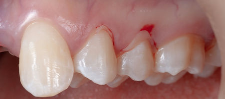 Compromized Implants .010.jpeg