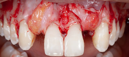 Compromized Implants .060.jpeg