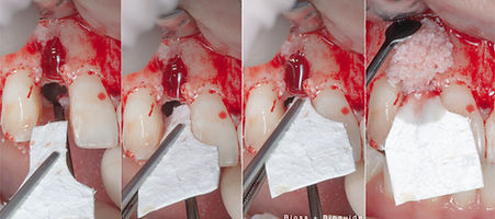 Compromized Implants .045.jpeg