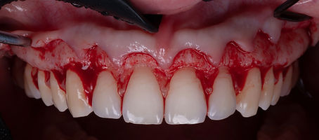 Crown lengthening .027.jpeg