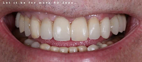 Gingival Impression Index Ricardo .033.jpeg