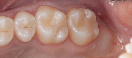 Compromized Implants .079.jpeg