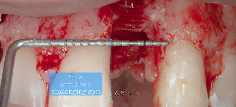 Compromized Implants .026.jpeg