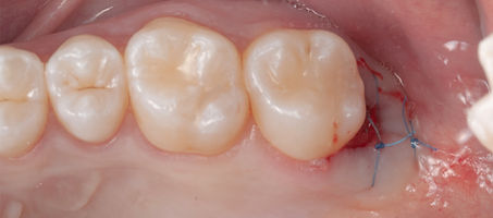 Compromized Implants .082.jpeg