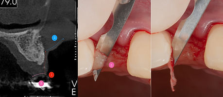 Compromized Implants .095.jpeg