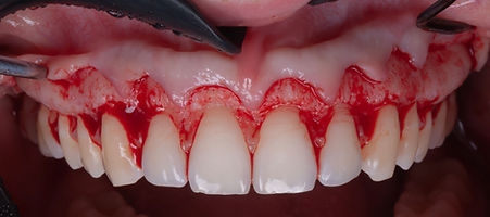 Crown lengthening .025.jpeg