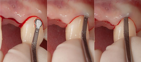 Compromized Implants .088.jpeg