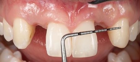 Compromized Implants .085.jpeg