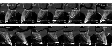 Compromized Implants .076.jpeg