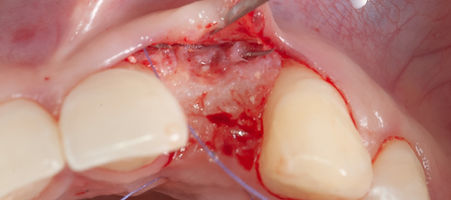 Compromized Implants .097.jpeg