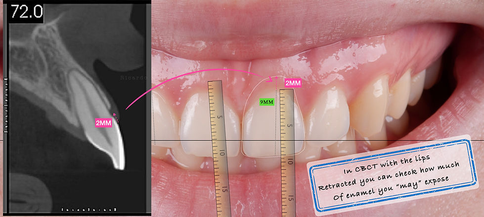 Crown lengthening .012.jpeg