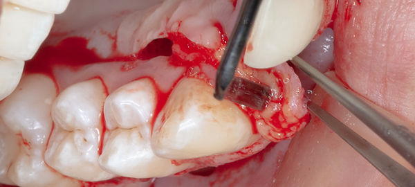 Compromized Implants .037.jpeg