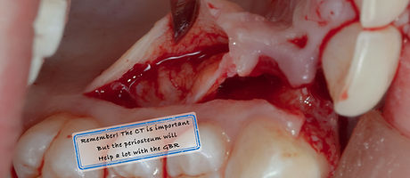 Compromized Implants .034.jpeg