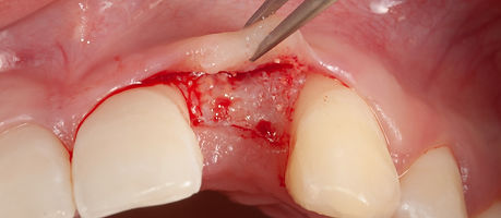 Compromized Implants .089.jpeg