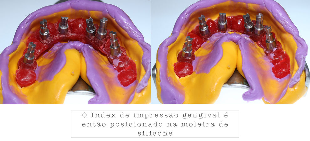 Gingival Impression Index Ricardo .037.jpeg