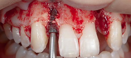 Compromized Implants .019.jpeg