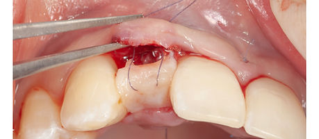 Compromized Implants .114.jpeg