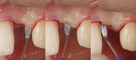 Compromized Implants .087.jpeg