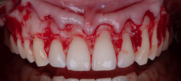Crown lengthening .034.jpeg