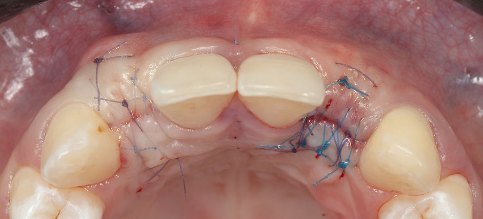 Compromized Implants .127.jpeg