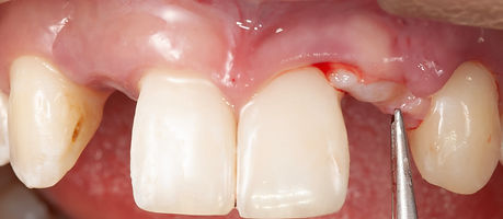 Compromized Implants .092.jpeg