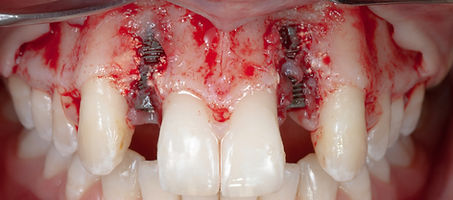 Compromized Implants .015.jpeg