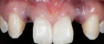 Compromized Implants .003.jpeg