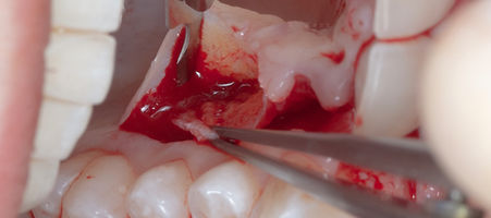 Compromized Implants .035.jpeg