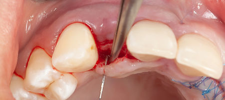 Compromized Implants .107.jpeg