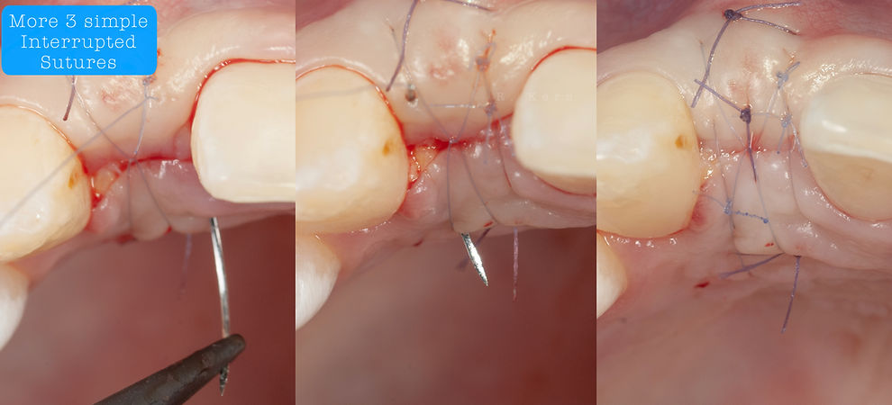 Compromized Implants .126.jpeg