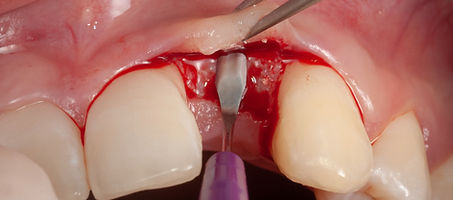 Compromized Implants .090.jpeg