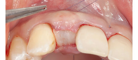 Compromized Implants .117.jpeg