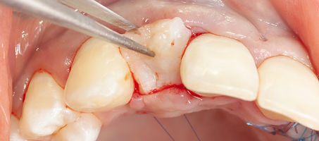 Compromized Implants .112.jpeg
