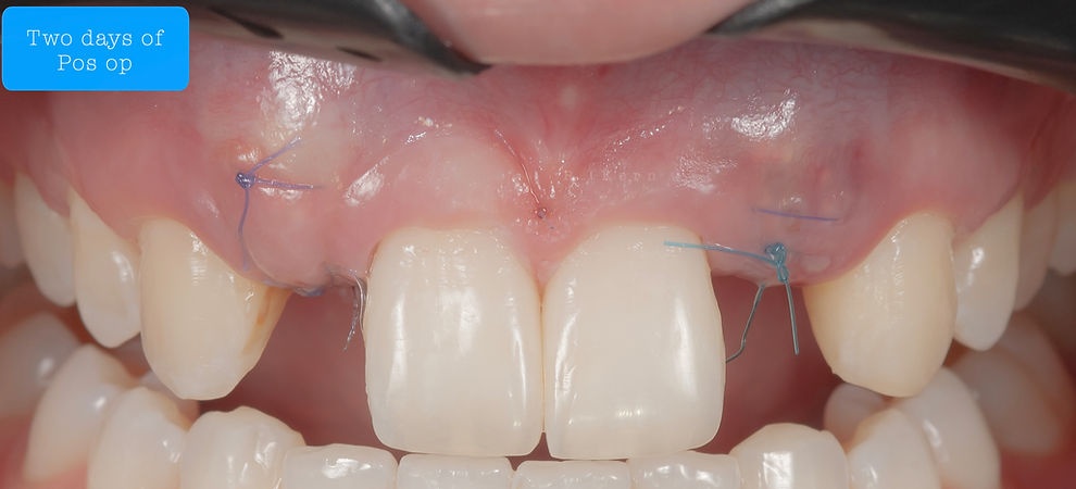 Compromized Implants .128.jpeg