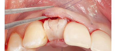 Compromized Implants .115.jpeg