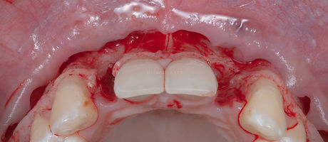 Compromized Implants .023.jpeg