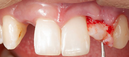 Compromized Implants .093.jpeg