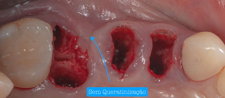 Implantes Imediatos .005.jpeg