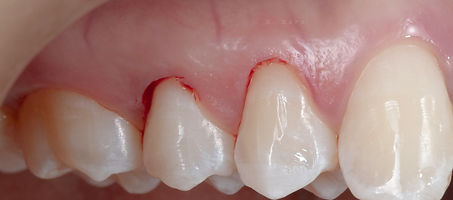 Compromized Implants .009.jpeg