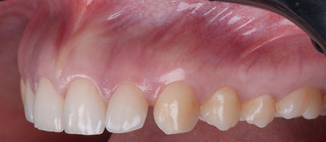 Crown lengthening .005.jpeg