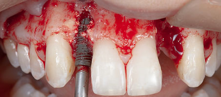 Compromized Implants .021.jpeg