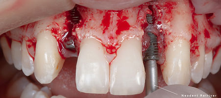 Compromized Implants .016.jpeg