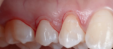 Compromized Implants .008.jpeg