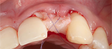 Compromized Implants .099.jpeg
