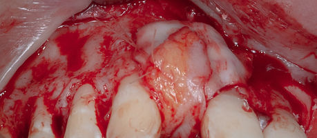 Compromized Implants .058.jpeg
