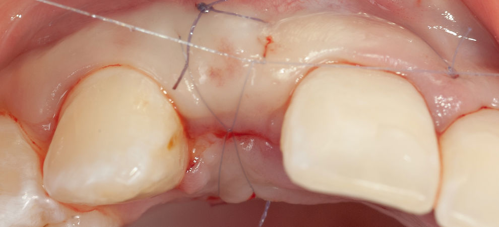 Compromized Implants .125.jpeg