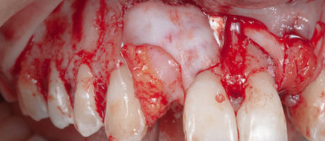 Compromized Implants .055.jpeg