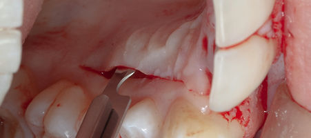 Compromized Implants .030.jpeg