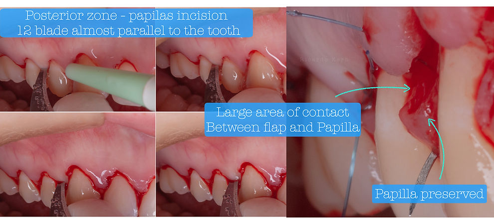 Crown lengthening .023.jpeg