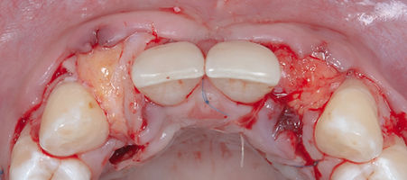 Compromized Implants .063.jpeg